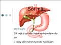 Sỏi mật (Cholelithiasis, gallstones)